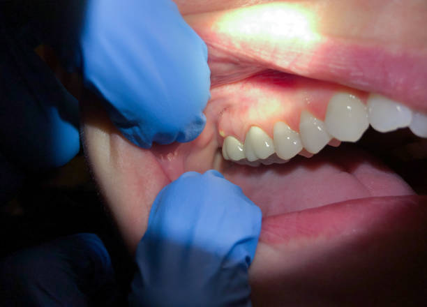 Best Urgent Care for Lost Fillings or Crowns in Crosspointe, VA